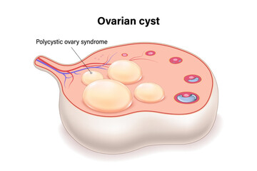 Polycystic ovary syndrome PCOS cross section vector. Ovarian cysts. Female ovarian disease.