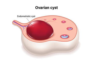 Endometriotic cyst cross section vector. Ovarian cysts. Female ovarian disease.