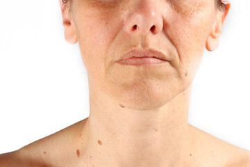 close-up on the wrinkles around the mouth of a 45-year-old woman , nasolabial folds