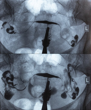 X-ray image of Hysterosalpingography (HSG). MRI with contrast agent. Patency of the uterus, ovaries and fallopian tubes. Uterine tubes, analysing female reproductive system. Infertility treatment.