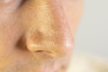 Naklejka premium Blackheads on mans nose. Acne problem, comedones. Close up.