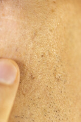 Fototapeta premium Scars after acne on mans face skin. Problem scin treatment. Close up.