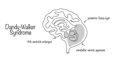 Dandy-Walker Syndrome