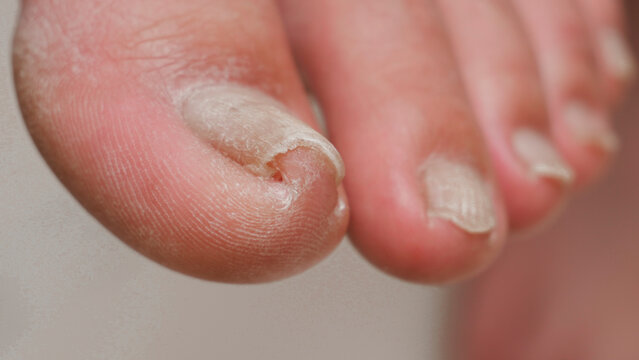 Ingrown toe nail growth in right toe causing a lot of pain