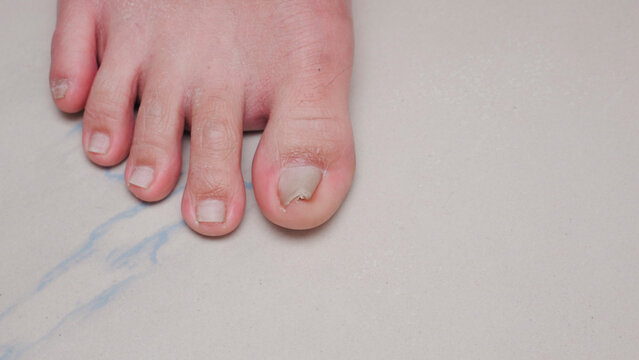 Ingrown toe nail growth in right toe causing a lot of pain