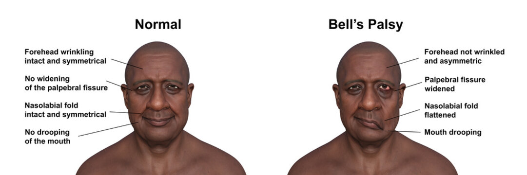 Facial palsy in a man, photorealistic 3D illustration