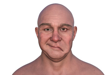 Facial palsy in a man, photorealistic 3D illustration
