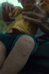 close up of young child with chicken pox on his skin