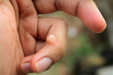 Finger wart on hand. Health concept. body wart
