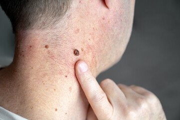 A man points his finger at a lump on his neck at a doctor's appointment. A mole in close-up