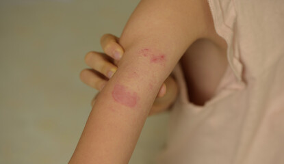 skin irritation after removing blood glucose monitoring system