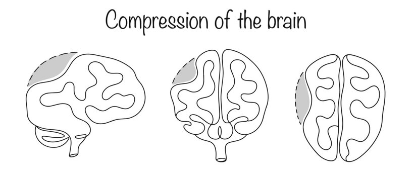 Compression of the brain