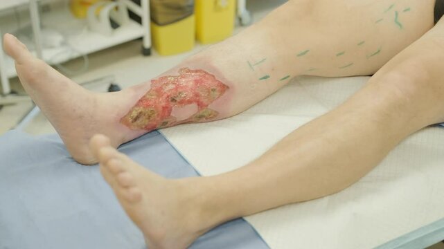 Application of BioGlue in Surgical Treatment of Leg Ulcer
