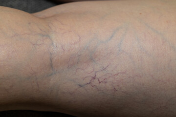 A woman has varicose veins on her thighs. Varicose veins in the leg.