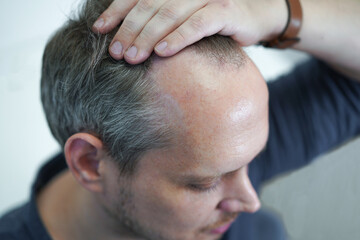 Baldness on the head of a middle-aged man. Hair loss. Alopecia