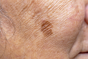 Fototapeta premium Woman's problematic skin pore and dark spots on the face