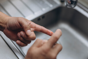 Man cut finger while cooking in kitchen, closeup