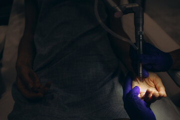 Doctor and nurse during birthmark removal dermatologic surgery in aesthetic medical clinic