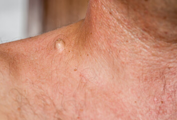 Atheroma, benign growth on the male body, close up