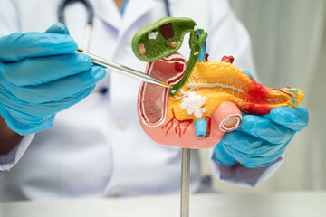 Pancreatitis, pancreatic cancer, Asian doctor with pancreas, gallbladder and bile duct human anatomy model at hospital.