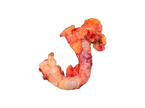 Appendix specimen from appendectomy, after surgery from the doctor.