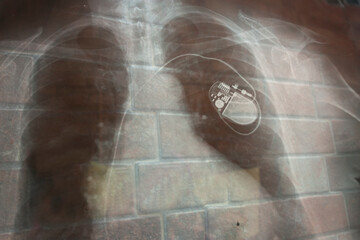 Chest X-ray revealing implanted cardiac pacemaker