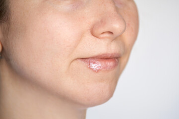 Obraz premium Close up of female face with cold sore treatment on lips - skincare concept for cold weather and lip health