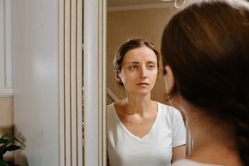 The girl looks at her problem skin in the mirror. The effects of stress and the onset of psoriasis...