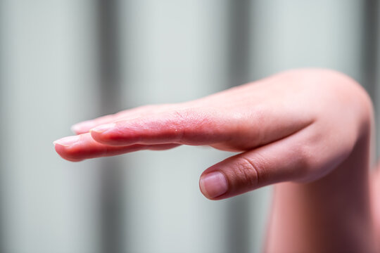 Macro closeup of female woman finger skin hand showing eczema medical condition called dyshidrotic pompholyx or vesicular dyshidrosis with blisters