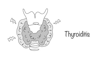 Thyroiditis