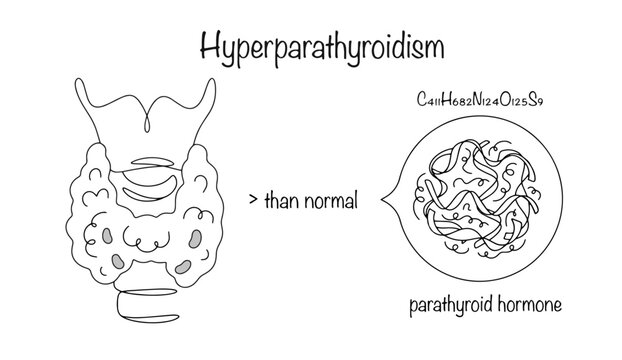 Hyperparathyroidism