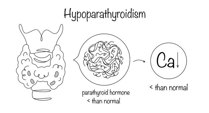 Hypoparathyroidism