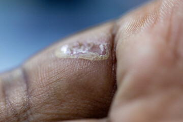 Wound and Scar on different parts of the body, Caused by an accident.	