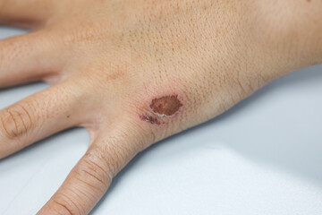 Wound and Scar on different parts of the body, Caused by an accident.	