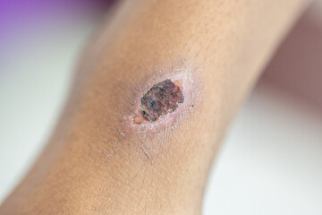 Wound and Scar on different parts of the body, Caused by an accident.	