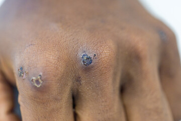 Wound and Scar on different parts of the body, Caused by an accident.	