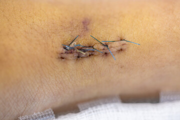 Wound and Scar on different parts of the body, Caused by an accident.	
