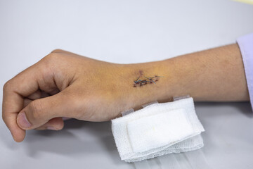 Wound and Scar on different parts of the body, Caused by an accident.	