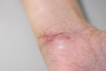 Fototapeta premium Wound and Scar on different parts of the body, Caused by an accident. 