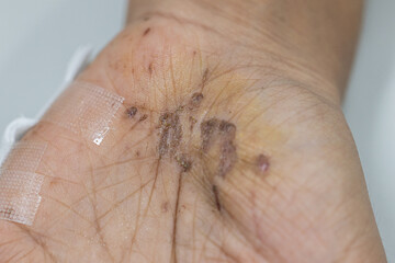 Wound and Scar on different parts of the body, Caused by an accident.	