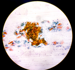 Light micrograph of a vaginal smear showing adenocarcinoma cells (center). Vaginal cancer....
