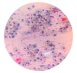 View in microscopic of Candidiasis, fungus infection (Yeast and Pseudohyphae form) in pap smear slide cytology and diagnostic by pathologist.Gynecology report and diagnosis