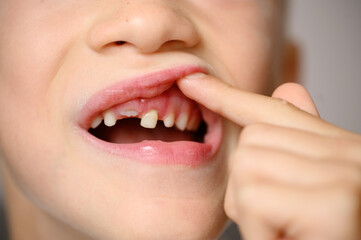 Child touching loose baby tooth, close-up. Baby teeth are replaced by permanent teeth. Children's...