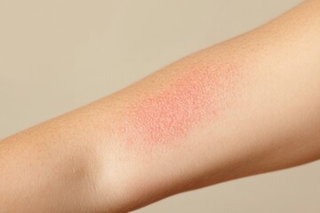 Close-up view of a skin allergy reaction on a person's arm showcasing redness and irritation