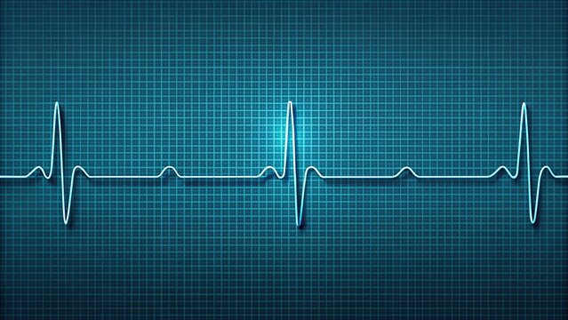 Minimalist illustration of normal atrial and ventricular depolarization on ECG waveform