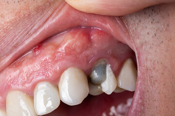 Caucasian male open mouth and teeth with broken upper premolar tooth after dental root canal...
