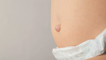 Baby belly with bulging navel on a gray background. Umbilical hernia in newborns, dilated umbilical...