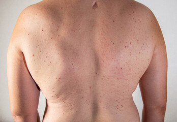 Fototapeta premium Red pimples on a man's back. Skin irritation and allergy concept. Diseases of the gastrointestinal tract, close-up