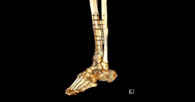 CT scan of ankle joint showing a fracture in the tibia and fibula bones. Detailed medical imaging perfect for educational, diagnostic, and healthcare content.