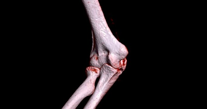 CT scan of the elbow joint displaying a clear fracture in the ulna bone, offering detailed medical imaging of bone injury for diagnostic or educational use.